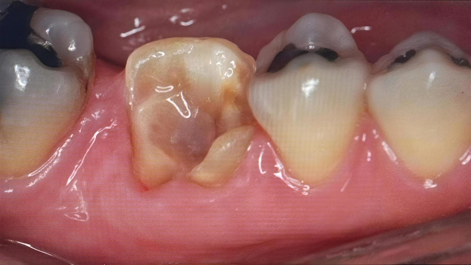 Antes del tratamiento: molar inferior con destrucción de la corona, reducido a muñón, entre dos piezas con amalgamas.