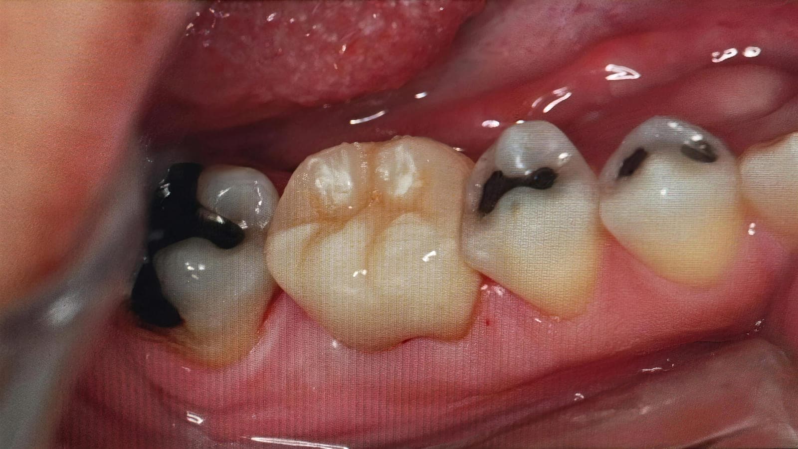 Después del tratamiento: el mismo molar rehabilitado con una corona que recupera la anatomía y el contacto con las piezas vecinas.