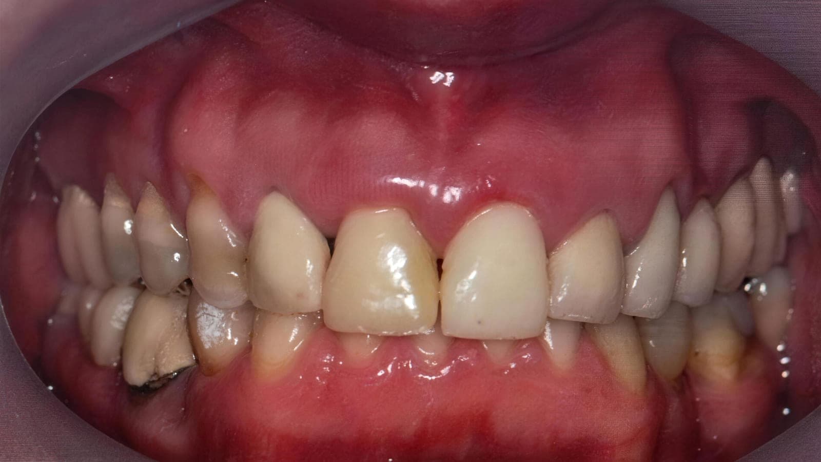 Antes del tratamiento: dientes superiores con desgaste y pigmentación, y encía inflamada por enfermedad periodontal.