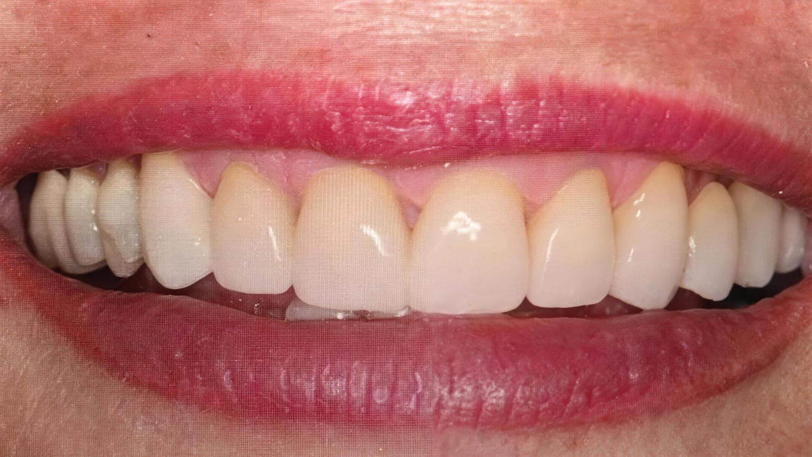 Después del tratamiento: sonrisa rehabilitada con coronas E-max y encía sana, en Dental St. Engracia.